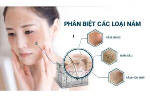 Nám Da Từ Đâu Mà Có? Cách Tránh Các Tác Nhân Hình Thành Nám