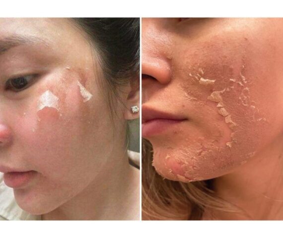Các Hiện Tượng Sau Khi Peel Da Khiến Bạn Hiểu Lầm Da Bị Tổn Thương