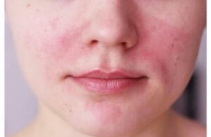 Các Hiện Tượng Sau Khi Peel Da Khiến Bạn Hiểu Lầm Da Bị Tổn Thương