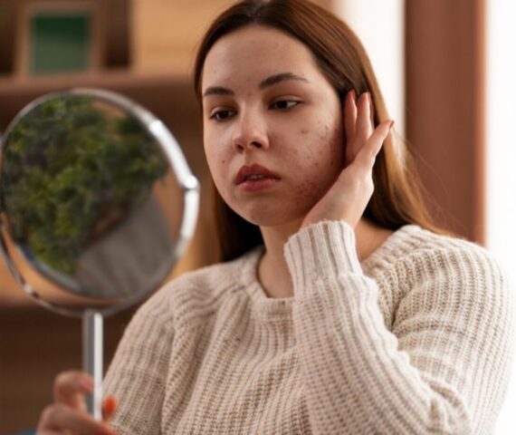 Cách Nhận Biết Mụn Nội Tiết Và Cách Chữa Hiệu Quả