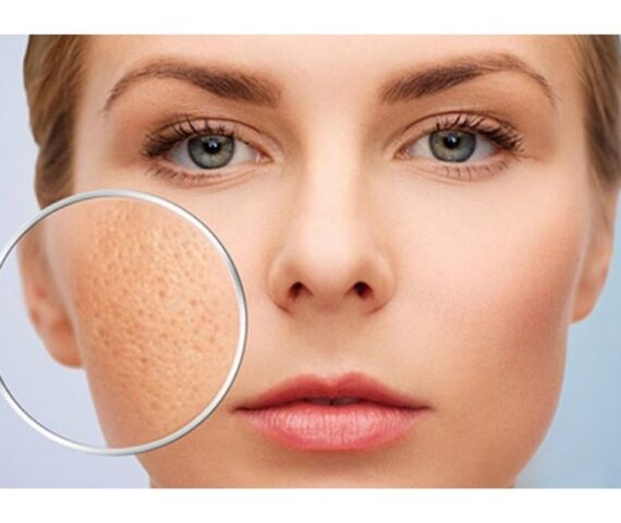 Lỗ Chân Lông Càng Ngày Càng To? Nguyên Nhân Do Đâu