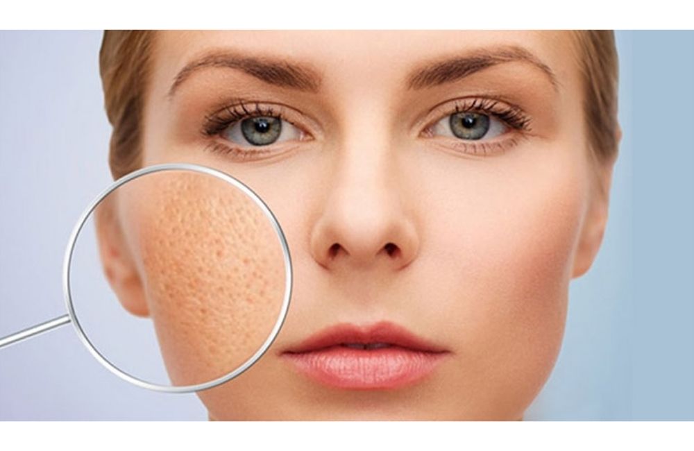 Lỗ Chân Lông Càng Ngày Càng To? Nguyên Nhân Do Đâu