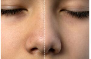 Lỗ Chân Lông Càng Ngày Càng To? Nguyên Nhân Do Đâu