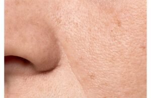 Lỗ Chân Lông Càng Ngày Càng To? Nguyên Nhân Do Đâu