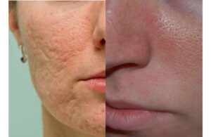 Lỗ Chân Lông Càng Ngày Càng To? Nguyên Nhân Do Đâu