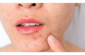Da Dễ Nổi Mụn Khi Thay Đổi Thời Tiết Xấu Đi? Lý Do Tại Sao? 4 Da Dễ Nổi Mụn Khi Thay Đổi Thời Tiết Xấu Đi? Lý Do Tại Sao?