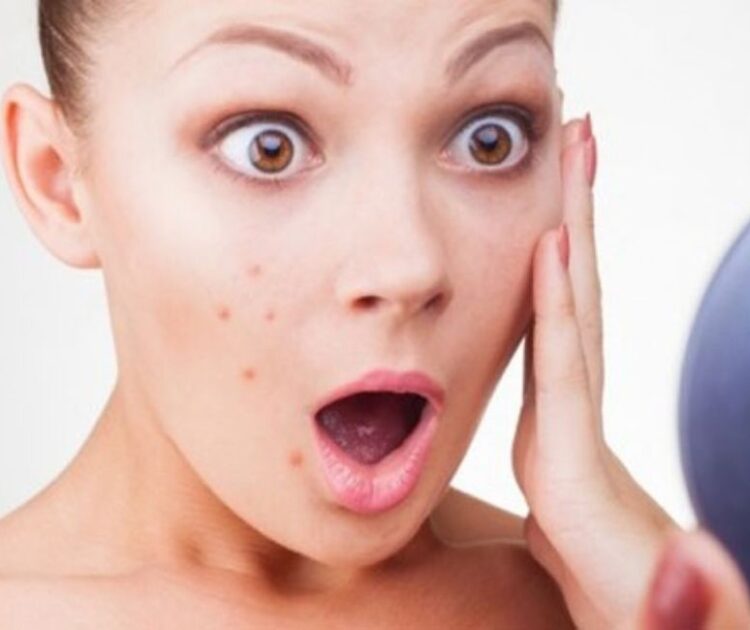 Da Dễ Nổi Mụn Khi Thay Đổi Thời Tiết Xấu Đi? Lý Do Tại Sao?
