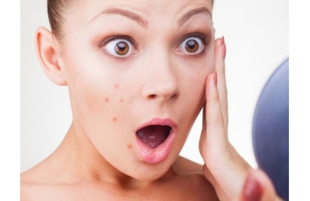 Da Dễ Nổi Mụn Khi Thay Đổi Thời Tiết Xấu Đi? Lý Do Tại Sao?