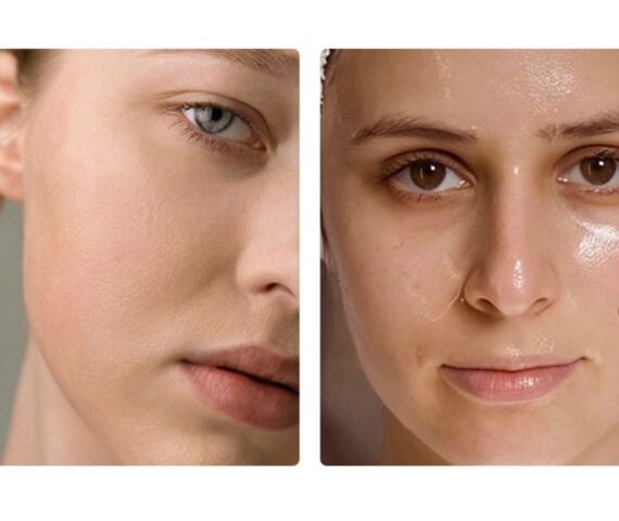 Da Dầu Cần Gì Da Khô Đang Thiếu Gì? Liệu Bạn Đã Thực Sự Hiểu