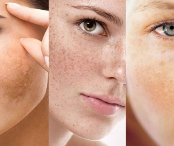 Nám Hình Thành Do Đâu? Biết Sớm Để Phòng Tránh Nám