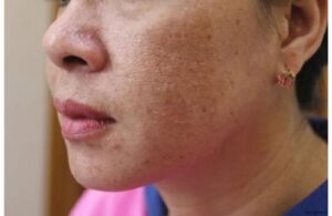 Nám Hình Thành Do Đâu? Biết Sớm Để Phòng Tránh Nám 2 Nám Hình Thành Do Đâu? Biết Sớm Để Phòng Tránh Nám