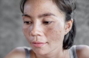 Nám Hình Thành Do Đâu? Biết Sớm Để Phòng Tránh Nám 4 Nám Hình Thành Do Đâu? Biết Sớm Để Phòng Tránh Nám