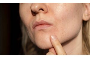 Cải Thiện Tình Trạng Da Khô Nứt Nẻ Do Thay Đổi Thời Tiết