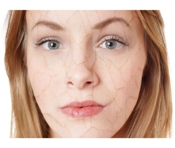 Cải Thiện Tình Trạng Da Khô Nứt Nẻ Do Thay Đổi Thời Tiết