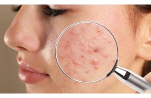 BHA Là Gì? Hiệu Quả Và Cách Sử Dụng Cho Người Mới Bắt Đầu 2 BHA Là Gì? Hiệu Quả Và Cách Sử Dụng Cho Người Mới Bắt Đầu