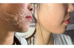 Peel Da Và Treatment Khác Nhau Ở Điểm Nào? Nên Chọn Phương Pháp Làm Đẹp Nào 2 Peel Da Và Treatment Khác Nhau Ở Điểm Nào? Nên Chọn Phương Pháp Làm Đẹp Nào