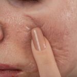 Peel Da Và Treatment Khác Nhau Ở Điểm Nào? Nên Chọn Phương Pháp Làm Đẹp Nào