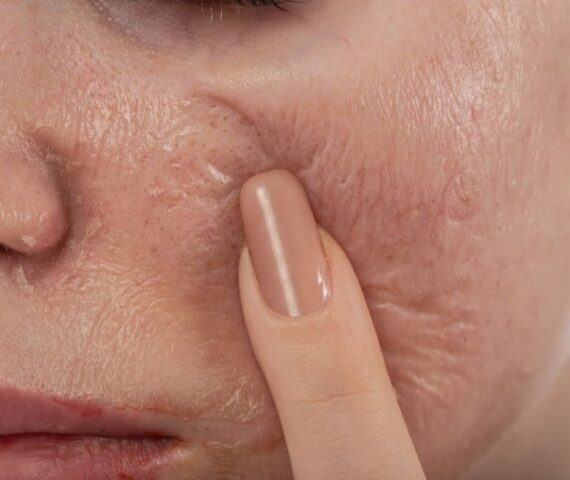 Peel Da Và Treatment Khác Nhau Ở Điểm Nào? Nên Chọn Phương Pháp Làm Đẹp Nào