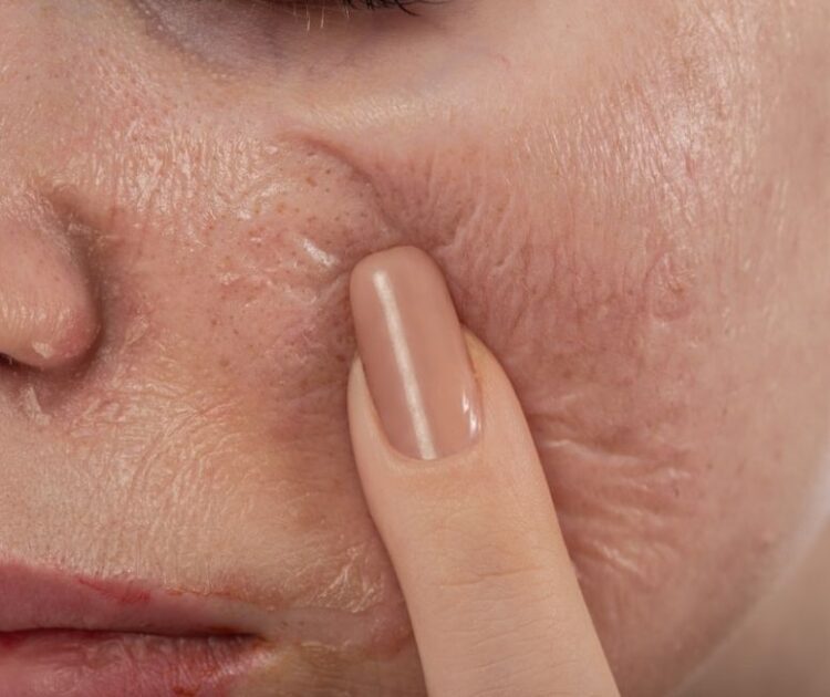 Peel Da Và Treatment Khác Nhau Ở Điểm Nào? Nên Chọn Phương Pháp Làm Đẹp Nào