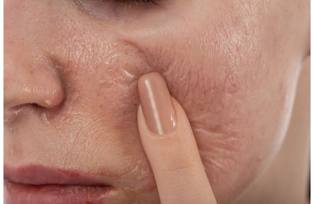 Peel Da Và Treatment Khác Nhau Ở Điểm Nào? Nên Chọn Phương Pháp Làm Đẹp Nào