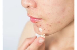 Những Hoạt Chất Tuyệt Đối Không Được Bôi Lên Da, Dừng Ngay Nếu Bạn Đang Dùng