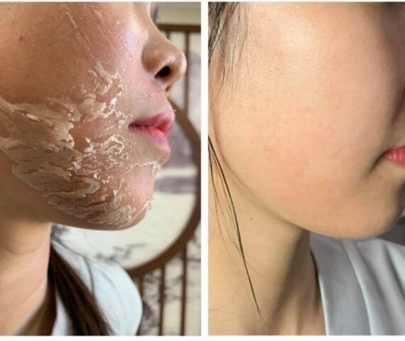 Peel Da Điều Trị Nám Có Thực Sự Hiệu Quả? Những Sự Thật Bạn Nên Biết Trước Khi Trị Nám