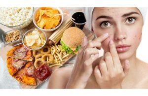 5 Thực Phẩm Ăn Khiến Da Nổi Mụn Đã Trở Thành Thói Quen Khó Bỏ Của Chúng Ta