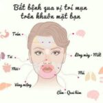 Vị Trí Mụn Mọc Trên Mặt Đang Cảnh Báo Điều Gì Về Sức Khỏe