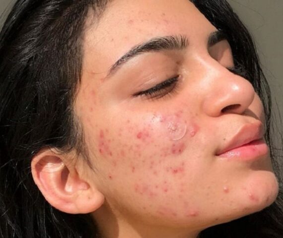 Quá Trình Đẩy Mụn Và Hết Mụn Sẽ Diễn Ra Như Thế Nào