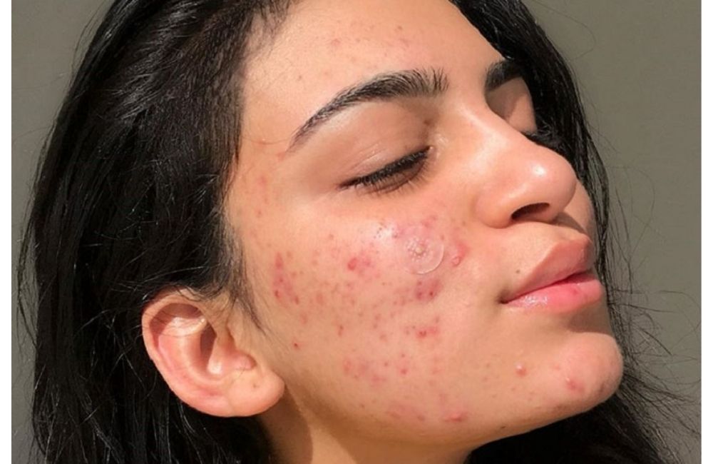 Quá Trình Đẩy Mụn Và Hết Mụn Sẽ Diễn Ra Như Thế Nào
