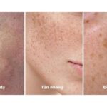 Nám Tàn Nhang & Đồi Mồi Giống Hay Khác Nhau? Cách Phân Biệt Để Chữa Trị Nhanh Nhất
