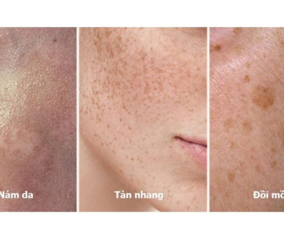 Nám Tàn Nhang & Đồi Mồi Giống Hay Khác Nhau? Cách Phân Biệt Để Chữa Trị Nhanh Nhất