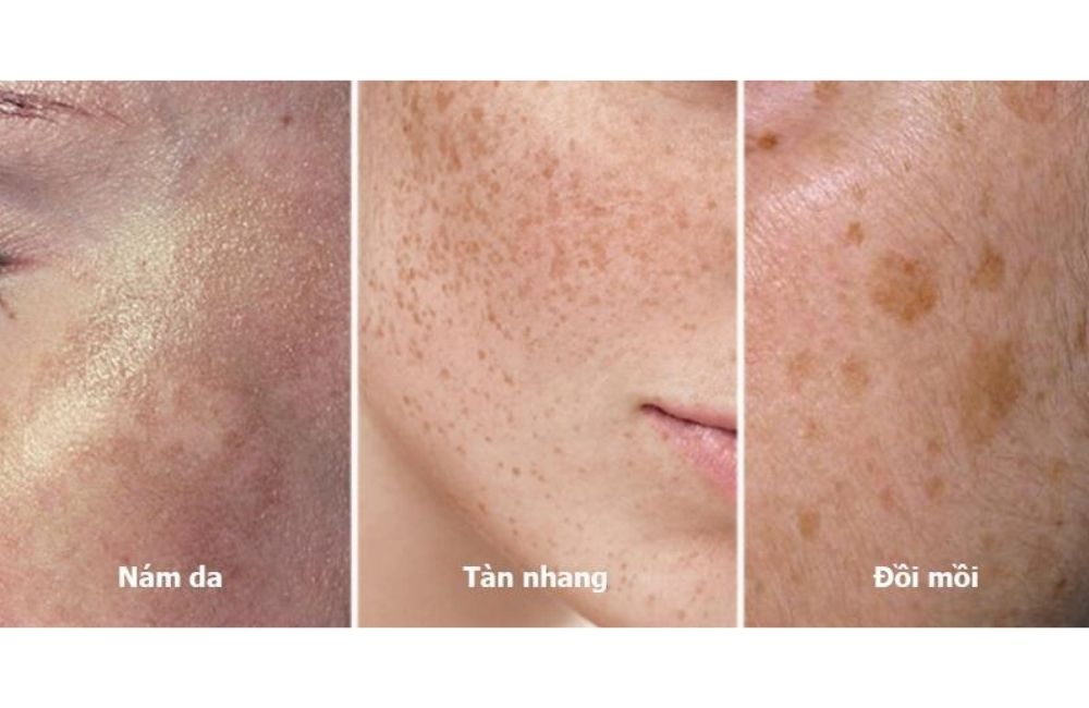 Nám Tàn Nhang & Đồi Mồi Giống Hay Khác Nhau? Cách Phân Biệt Để Chữa Trị Nhanh Nhất