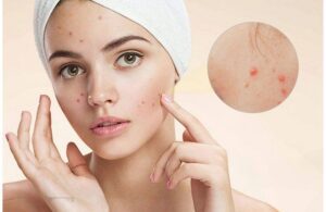 Vị Trí Mụn Mọc Trên Mặt Đang Cảnh Báo Điều Gì Về Sức Khỏe 2 Vị Trí Mụn Mọc Trên Mặt Đang Cảnh Báo Điều Gì Về Sức Khỏe
