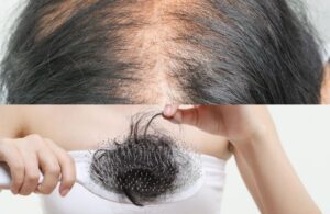 Cách Khắc Phục Bệnh Rụng Tóc Ở Nữ Giới: Nguyên Nhân Và Giải Pháp Hiệu Quả