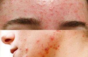 Quá Trình Đẩy Mụn Và Hết Mụn Sẽ Diễn Ra Như Thế Nào 2 Quá Trình Đẩy Mụn Và Hết Mụn Sẽ Diễn Ra Như Thế Nào
