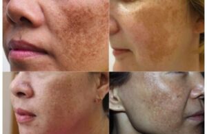 Nám Tàn Nhang & Đồi Mồi Giống Hay Khác Nhau? Cách Phân Biệt Để Chữa Trị Nhanh Nhất 3 Nám Tàn Nhang & Đồi Mồi Giống Hay Khác Nhau? Cách Phân Biệt Để Chữa Trị Nhanh Nhất