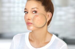Quá Trình Đẩy Mụn Và Hết Mụn Sẽ Diễn Ra Như Thế Nào 3 Quá Trình Đẩy Mụn Và Hết Mụn Sẽ Diễn Ra Như Thế Nào