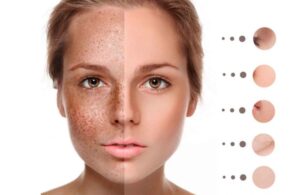 Nám Tàn Nhang & Đồi Mồi Giống Hay Khác Nhau? Cách Phân Biệt Để Chữa Trị Nhanh Nhất 2 Nám Tàn Nhang & Đồi Mồi Giống Hay Khác Nhau? Cách Phân Biệt Để Chữa Trị Nhanh Nhất