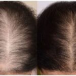 Cách Khắc Phục Bệnh Rụng Tóc Ở Nữ Giới: Nguyên Nhân Và Giải Pháp Hiệu Quả