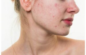 Vị Trí Mụn Mọc Trên Mặt Đang Cảnh Báo Điều Gì Về Sức Khỏe 4 Vị Trí Mụn Mọc Trên Mặt Đang Cảnh Báo Điều Gì Về Sức Khỏe