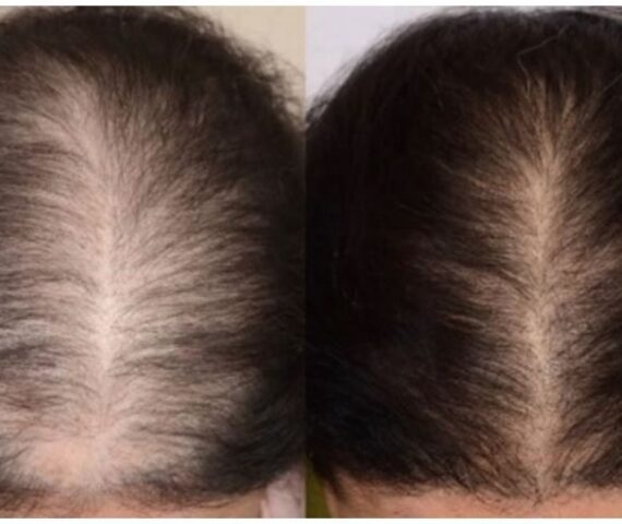 Cách Khắc Phục Bệnh Rụng Tóc Ở Nữ Giới: Nguyên Nhân Và Giải Pháp Hiệu Quả