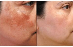 Nám Tàn Nhang & Đồi Mồi Giống Hay Khác Nhau? Cách Phân Biệt Để Chữa Trị Nhanh Nhất 4 Nám Tàn Nhang & Đồi Mồi Giống Hay Khác Nhau? Cách Phân Biệt Để Chữa Trị Nhanh Nhất
