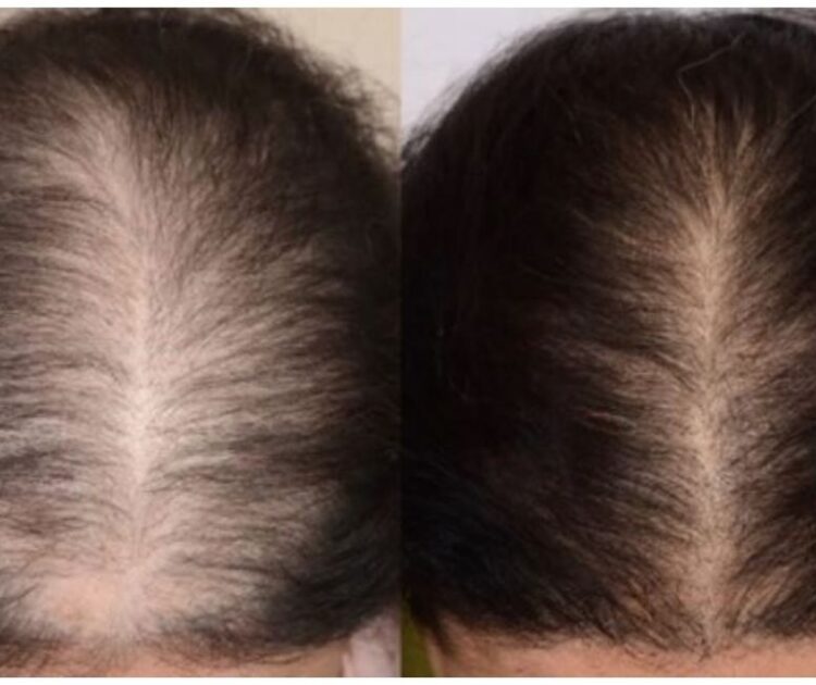 Cách Khắc Phục Bệnh Rụng Tóc Ở Nữ Giới: Nguyên Nhân Và Giải Pháp Hiệu Quả