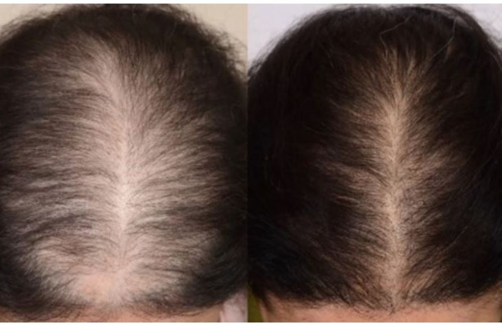Cách Khắc Phục Bệnh Rụng Tóc Ở Nữ Giới: Nguyên Nhân Và Giải Pháp Hiệu Quả