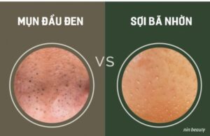 Giải Quyết Triệt Để Mụn Đầu Đen Và Sợi Bã Nhờn Bằng Phương Pháp Nào? 2 Giải Quyết Triệt Để Mụn Đầu Đen Và Sợi Bã Nhờn Bằng Phương Pháp Nào?