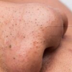 Giải Quyết Triệt Để Mụn Đầu Đen Và Sợi Bã Nhờn Bằng Phương Pháp Nào?