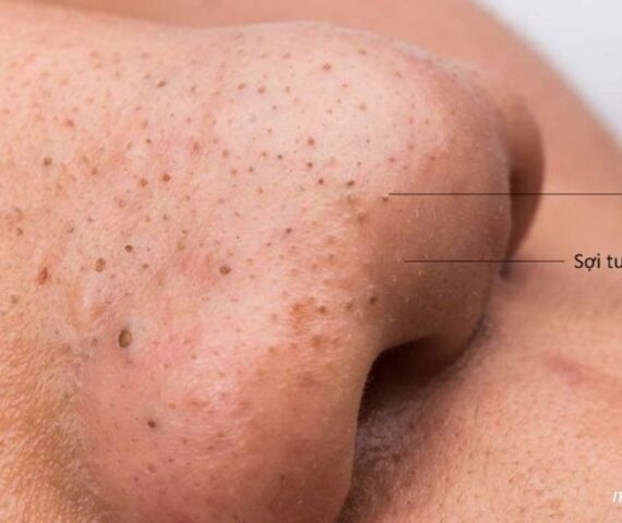 Giải Quyết Triệt Để Mụn Đầu Đen Và Sợi Bã Nhờn Bằng Phương Pháp Nào?