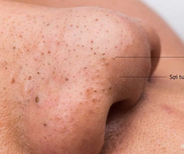 Giải Quyết Triệt Để Mụn Đầu Đen Và Sợi Bã Nhờn Bằng Phương Pháp Nào?