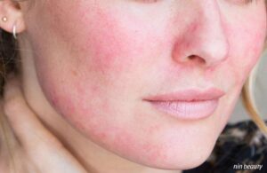 Tips Chăm Sóc Da Nhạy Cảm Trong Thời Tiết Hanh Khô Tháng 11 2 Tips Chăm Sóc Da Nhạy Cảm Trong Thời Tiết Hanh Khô Tháng 11